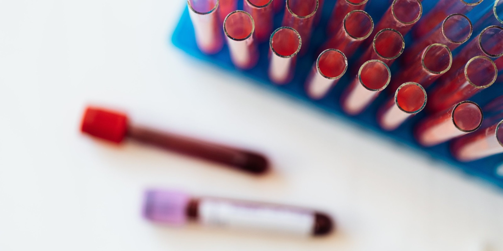 10 Signs You Might Be Low on Iron and Need a Blood Test