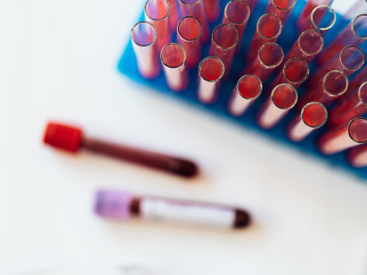 10 Signs You Might Be Low on Iron and Need a Blood Test