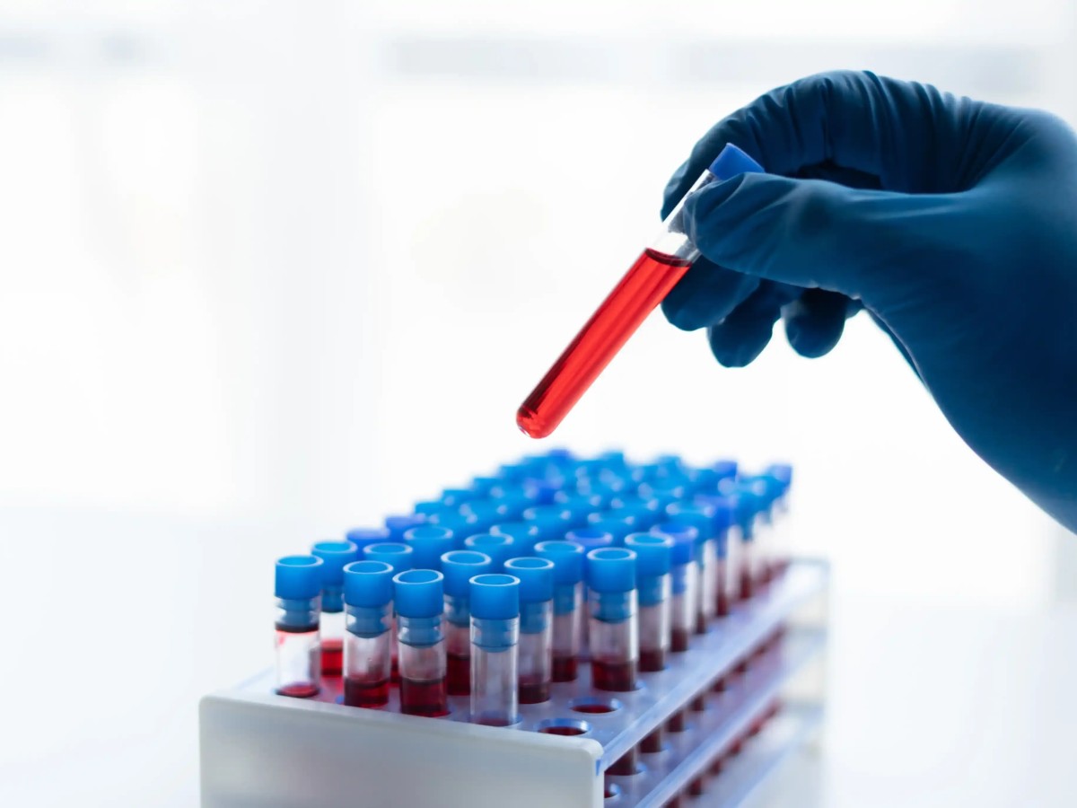 What Blood Tests You Can Easily Get Done at Home in Sharjah